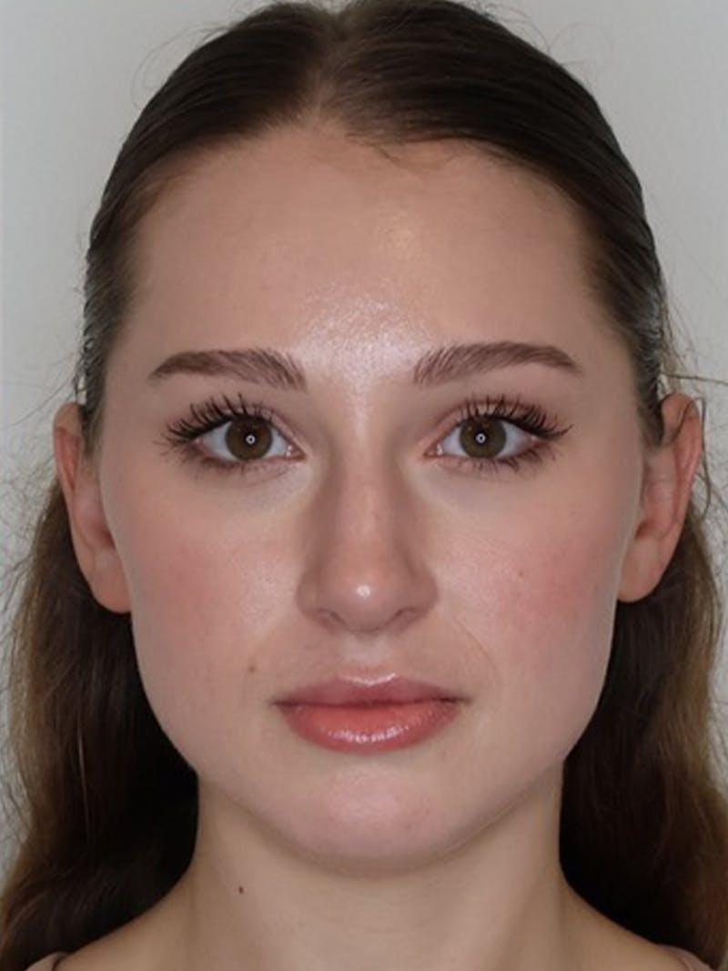 Rhinoplasty/Nose Reshaping Before & After Gallery - Patient 331514 - Image 6