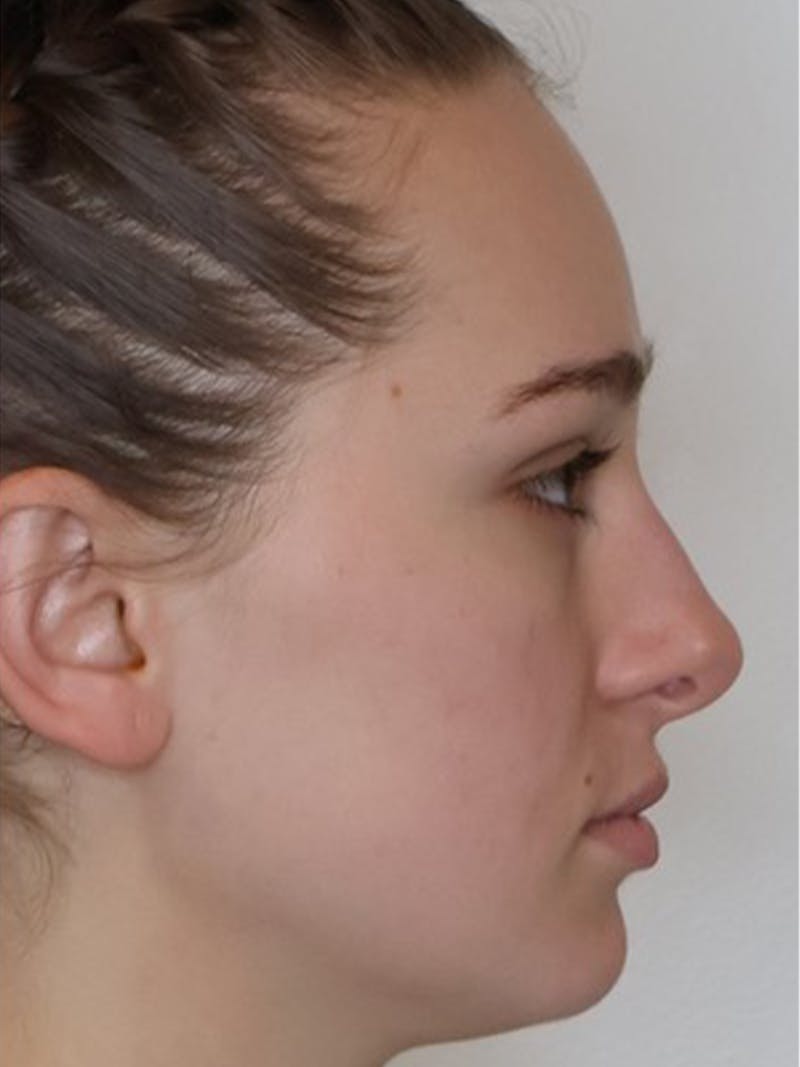 Rhinoplasty/Nose Reshaping Before & After Gallery - Patient 331514 - Image 1