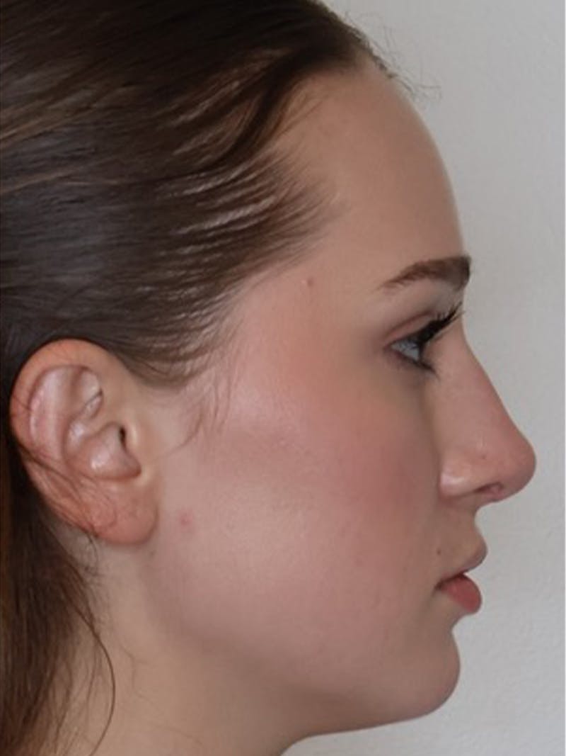 Rhinoplasty/Nose Reshaping Before & After Gallery - Patient 331514 - Image 2