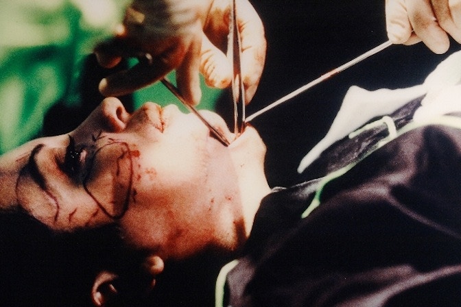 Orlan__The_second_mouth__7th_surgery-performance_titled_Omnipresence__New_York__1993