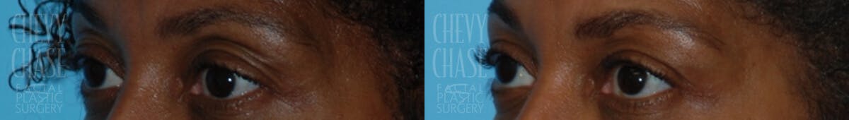 Blepharoplasty Before & After Gallery - Patient 106387250 - Image 2