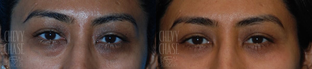 Blepharoplasty Before & After Gallery - Patient 106387254 - Image 1
