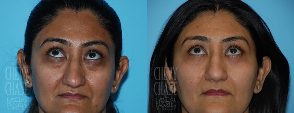 Blepharoplasty Before & After Gallery - Patient 106387254 - Image 2