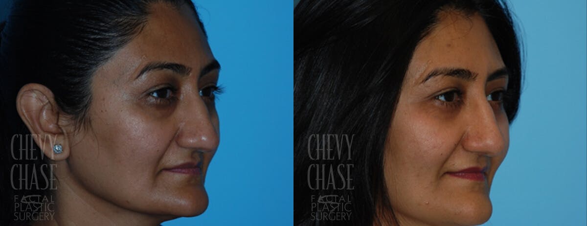 Blepharoplasty Before & After Gallery - Patient 106387254 - Image 3