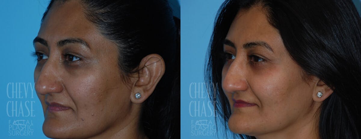 Blepharoplasty Before & After Gallery - Patient 106387254 - Image 4