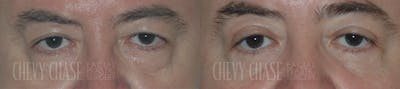 Blepharoplasty Before & After Gallery - Patient 106387255 - Image 1