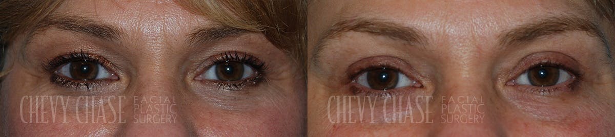 Blepharoplasty Before & After Gallery - Patient 106387257 - Image 1