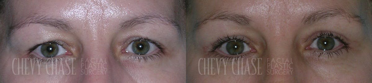Blepharoplasty Before & After Gallery - Patient 106387259 - Image 1