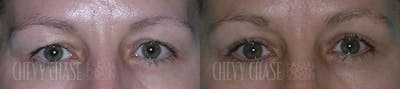 Blepharoplasty Before & After Gallery - Patient 106387259 - Image 1