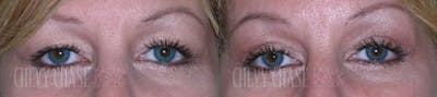 Blepharoplasty Before & After Gallery - Patient 106387260 - Image 1