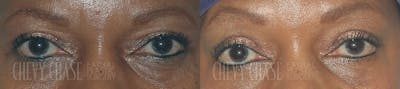 Blepharoplasty Before & After Gallery - Patient 106387261 - Image 1