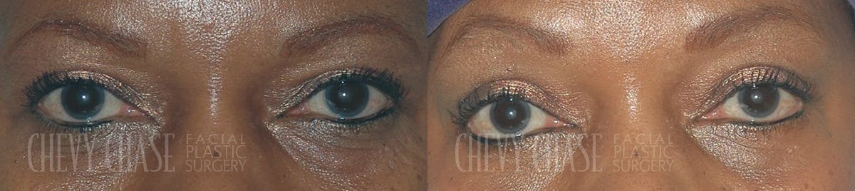 Blepharoplasty Before & After Gallery - Patient 106387261 - Image 1