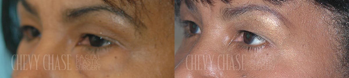 Blepharoplasty Before & After Gallery - Patient 106387262 - Image 1