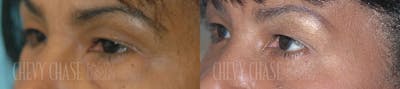 Blepharoplasty Before & After Gallery - Patient 106387262 - Image 1