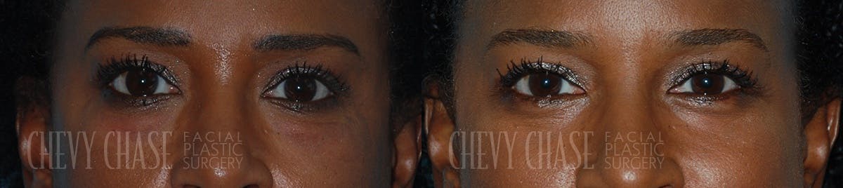 Blepharoplasty Before & After Gallery - Patient 106387263 - Image 1