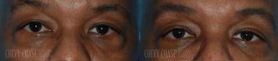 Blepharoplasty Before & After Gallery - Patient 106387265 - Image 1