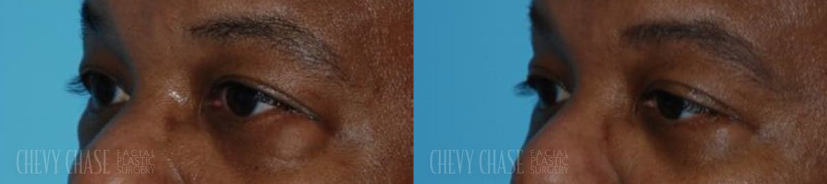 Blepharoplasty Before & After Gallery - Patient 106387265 - Image 2