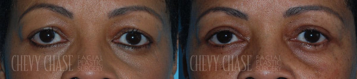 Blepharoplasty Before & After Gallery - Patient 106387266 - Image 1