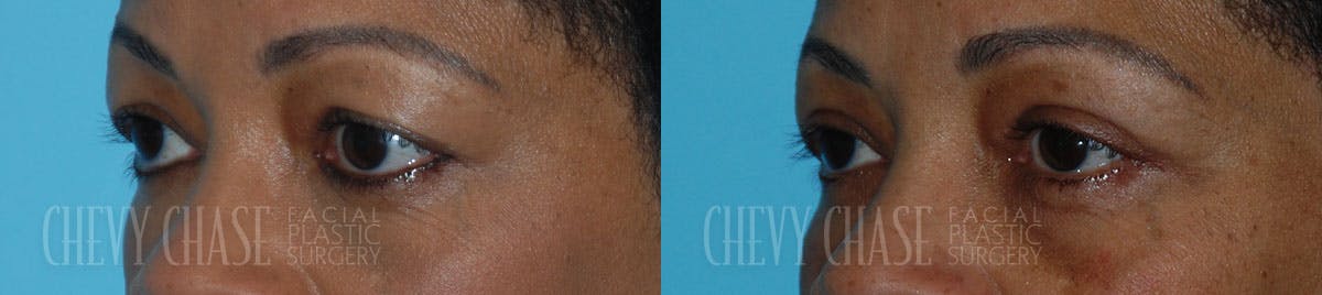 Blepharoplasty Before & After Gallery - Patient 106387266 - Image 2