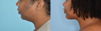 Chin Implant Before & After Gallery - Patient 106387346 - Image 1