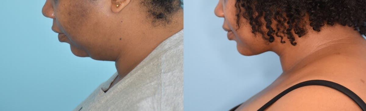 Chin Implant Before & After Gallery - Patient 106387346 - Image 4
