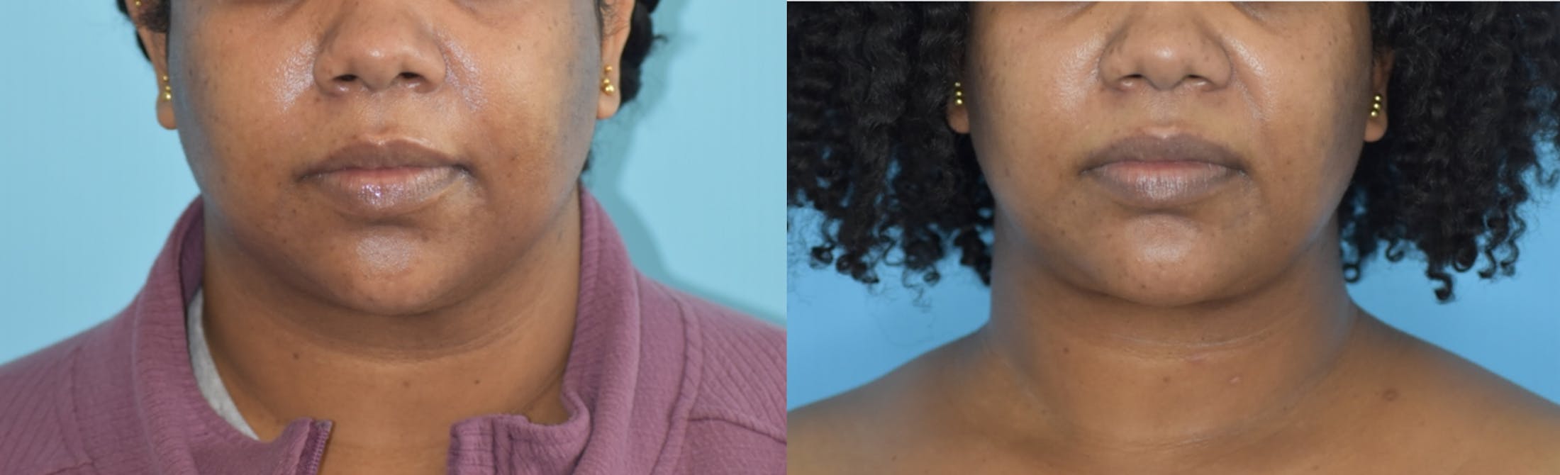 Chin Implant Before & After Gallery - Patient 106387346 - Image 5
