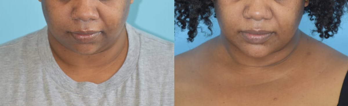 Chin Implant Before & After Gallery - Patient 106387346 - Image 6