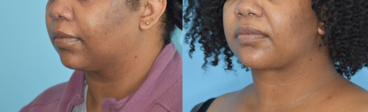Chin Implant Before & After Gallery - Patient 106387346 - Image 7