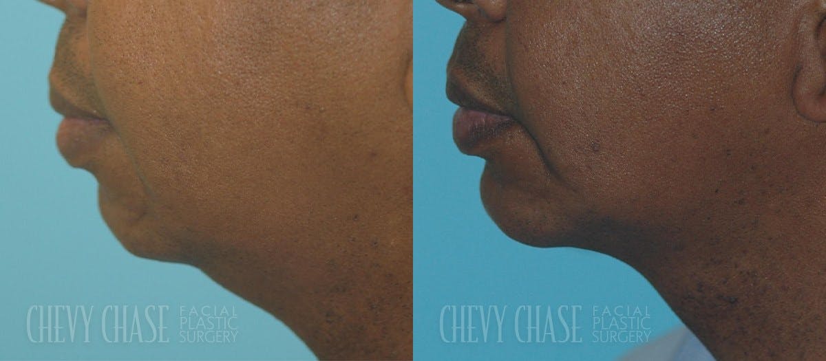 Chin Implant Before & After Gallery - Patient 106387351 - Image 1