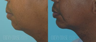 Chin Implant Before & After Gallery - Patient 106387351 - Image 1