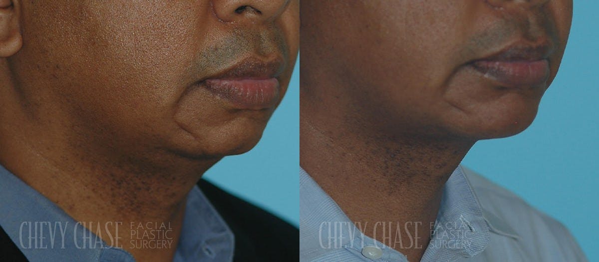 Chin Implant Before & After Gallery - Patient 106387351 - Image 2