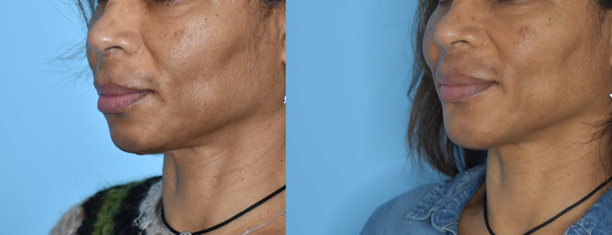 Chin Implant Before & After Gallery - Patient 106387353 - Image 1