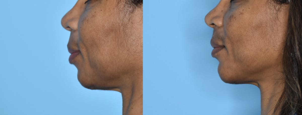 Chin Implant Before & After Gallery - Patient 106387353 - Image 2