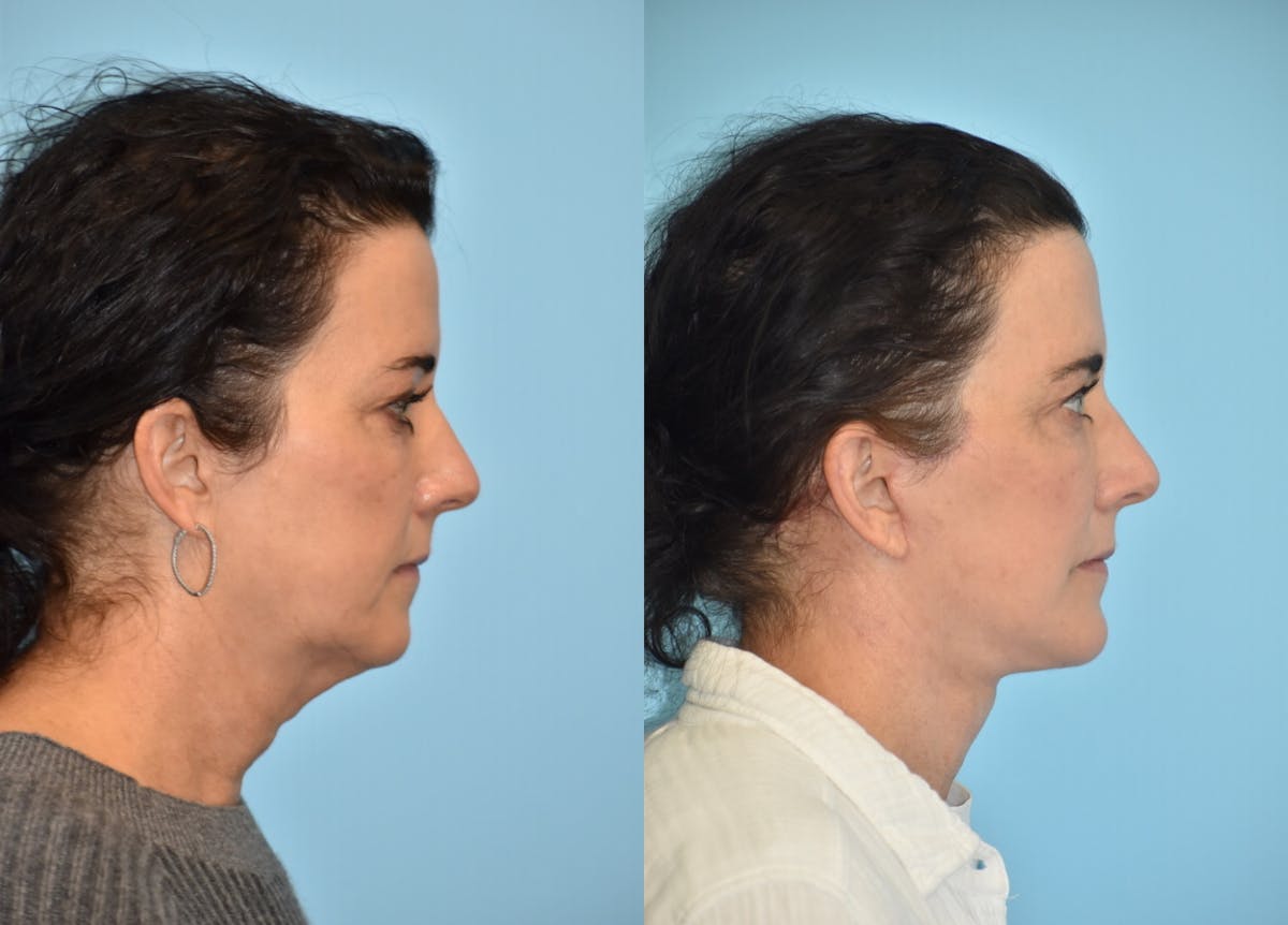 Chin Implant Before & After Gallery - Patient 106387356 - Image 2