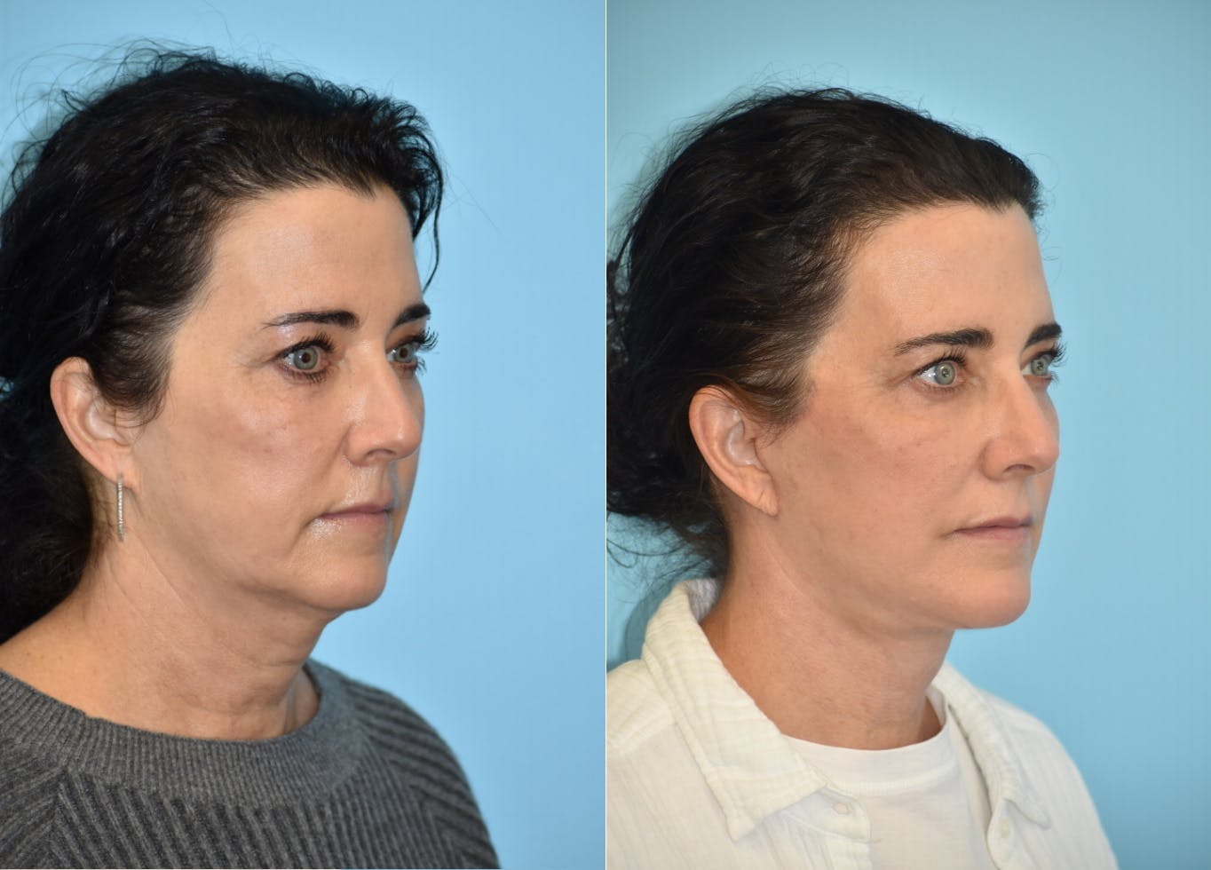 Chin Implant Before & After Gallery - Patient 106387356 - Image 3