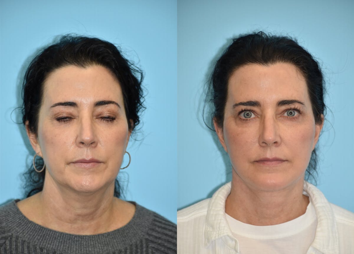 Chin Implant Before & After Gallery - Patient 106387356 - Image 4