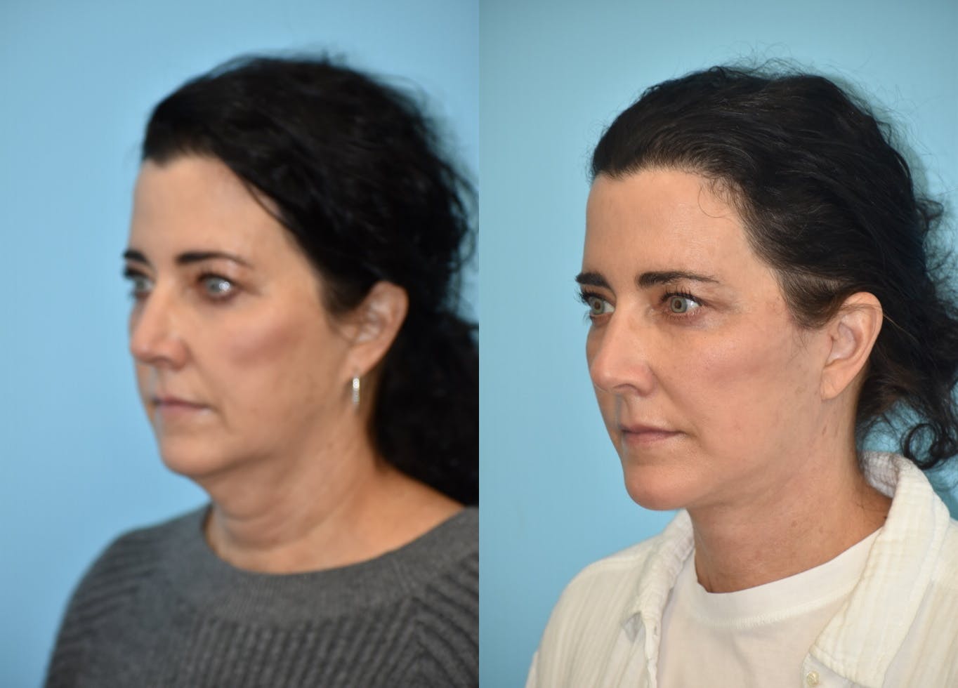 Chin Implant Before & After Gallery - Patient 106387356 - Image 5