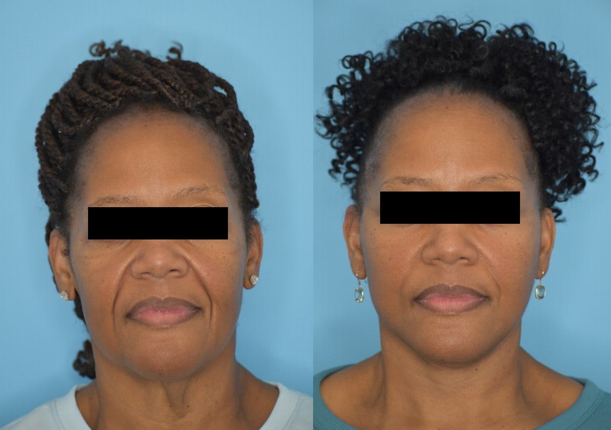Facelift And Necklift Before & After Gallery - Patient 106387404 - Image 1