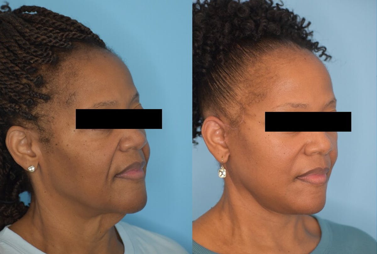 Facelift And Necklift Before & After Gallery - Patient 106387404 - Image 2