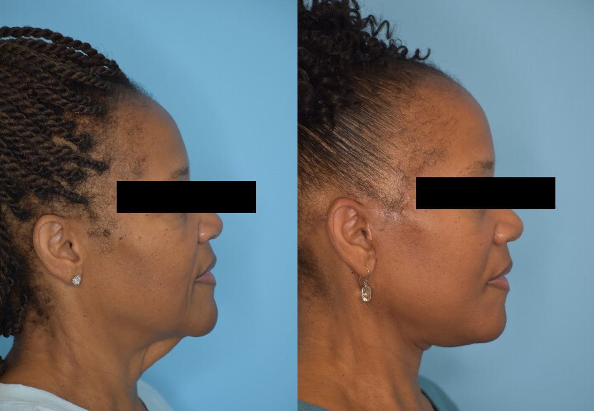 Facelift And Necklift Before & After Gallery - Patient 106387404 - Image 3
