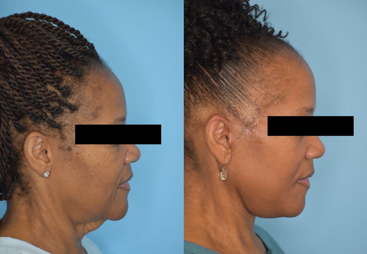 Facelift And Necklift Before & After Gallery - Patient 106387404 - Image 4