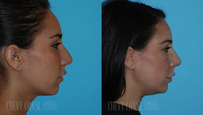 Revision Rhinoplasty Before & After Gallery - Patient 106387403 - Image 1