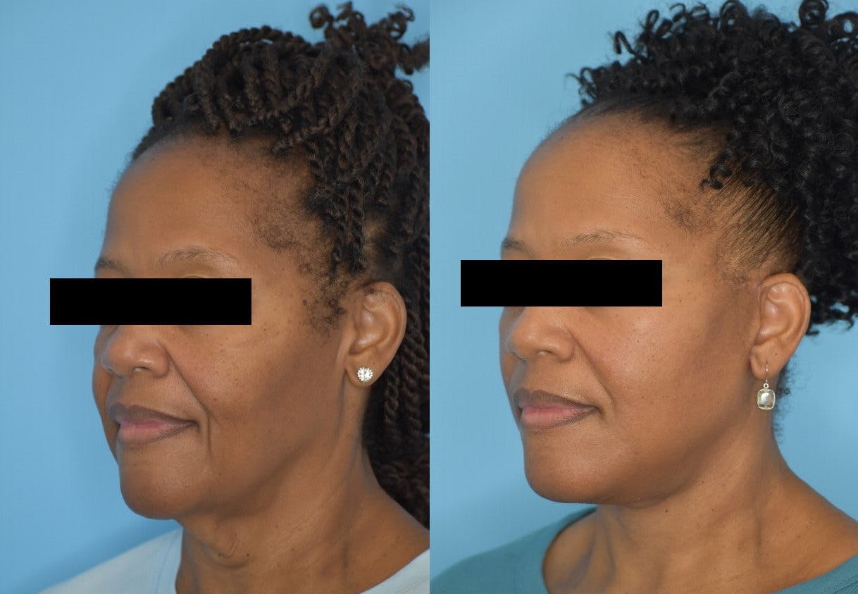 Facelift And Necklift Before & After Gallery - Patient 106387404 - Image 5