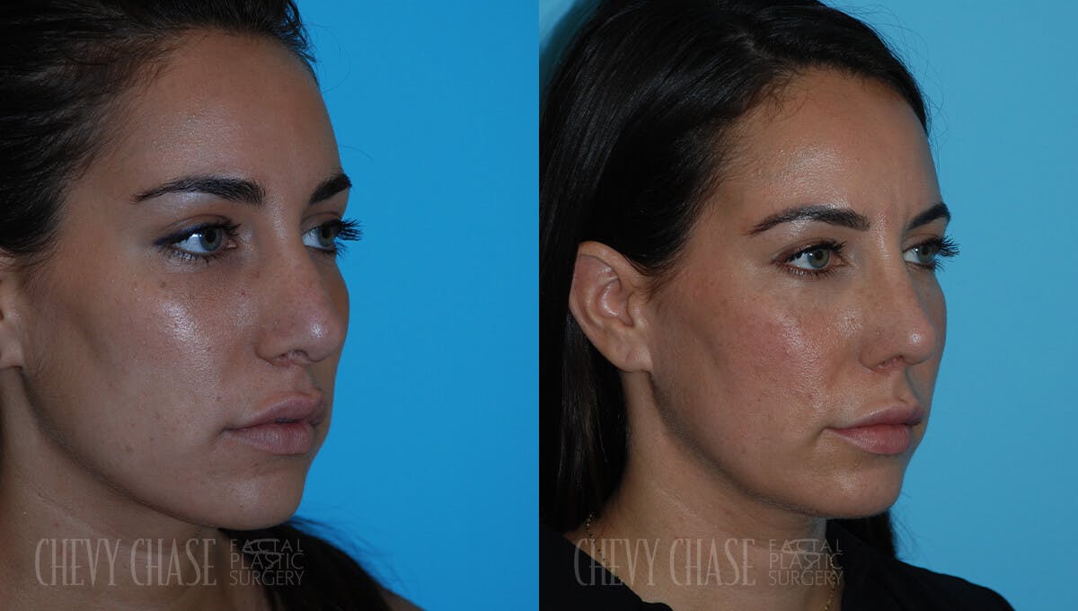 Revision Rhinoplasty Before & After Gallery - Patient 106387403 - Image 2
