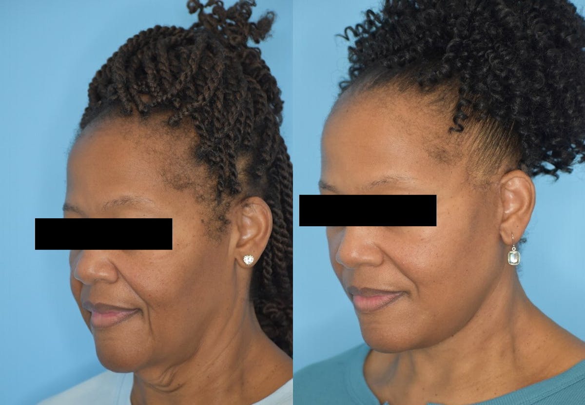 Facelift And Necklift Before & After Gallery - Patient 106387404 - Image 6
