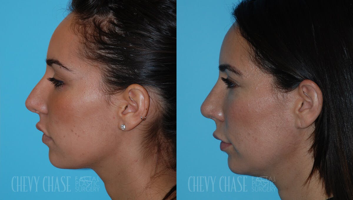Revision Rhinoplasty Before & After Gallery - Patient 106387403 - Image 3