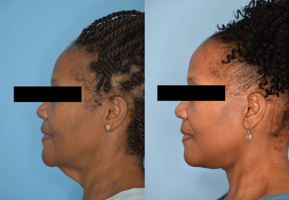Facelift And Necklift Before & After Gallery - Patient 106387404 - Image 7