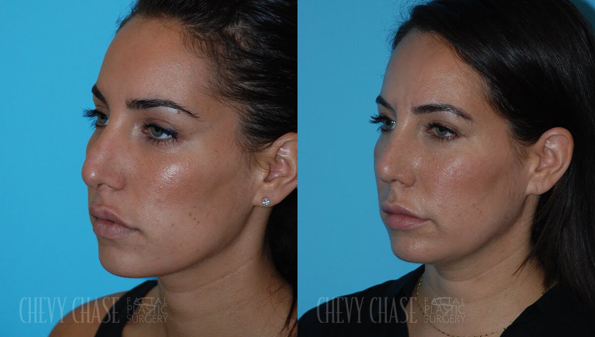 Revision Rhinoplasty Before & After Gallery - Patient 106387403 - Image 4