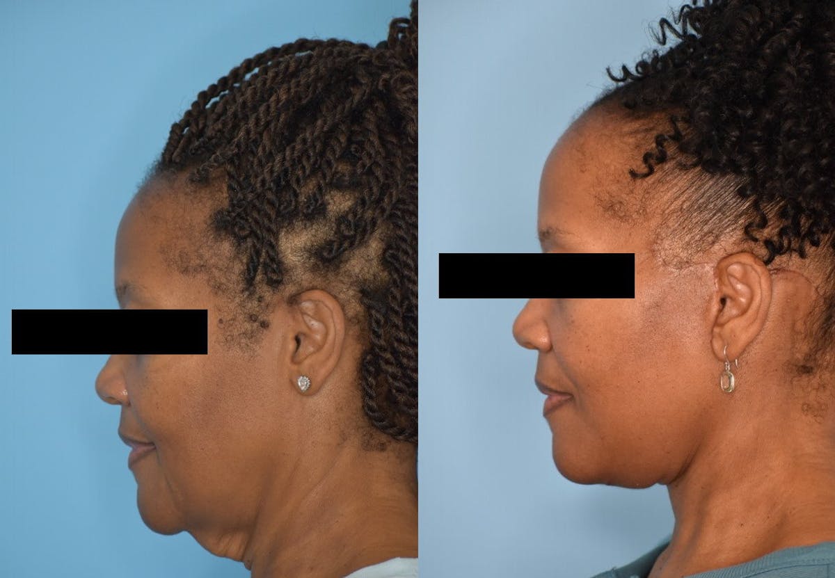 Facelift And Necklift Before & After Gallery - Patient 106387404 - Image 8
