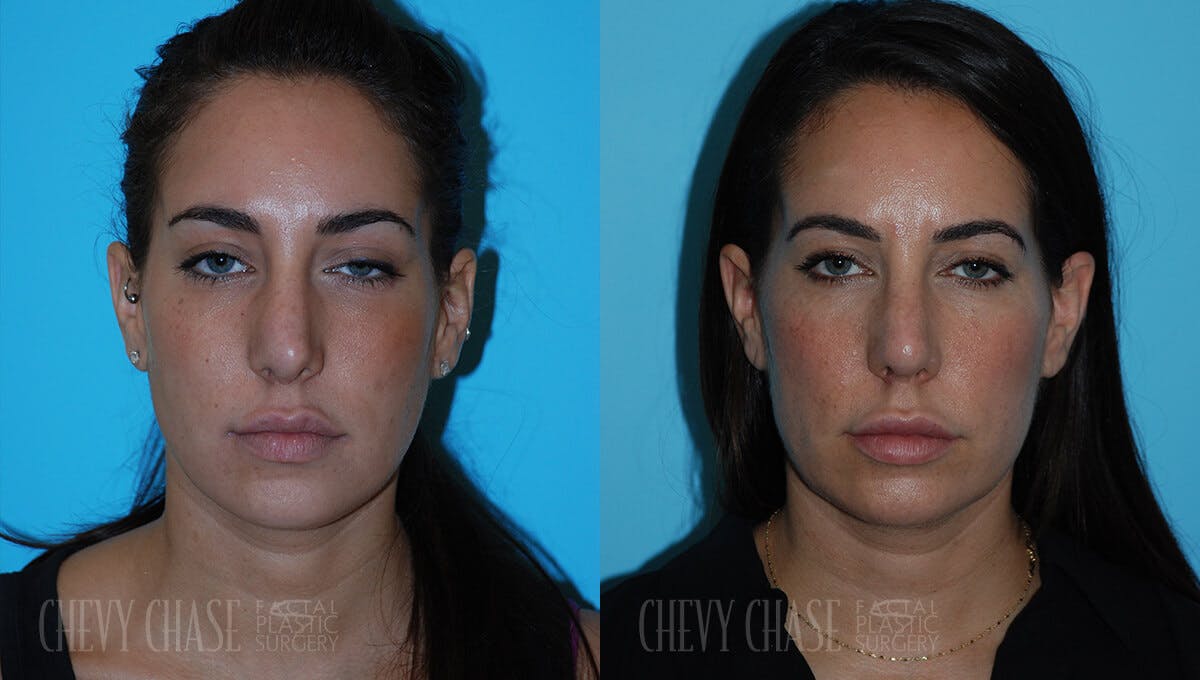 Revision Rhinoplasty Before & After Gallery - Patient 106387403 - Image 5